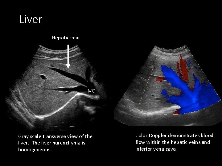 Liver Hepatic vein IVC Gray scale transverse view of the liver. The liver parenchyma