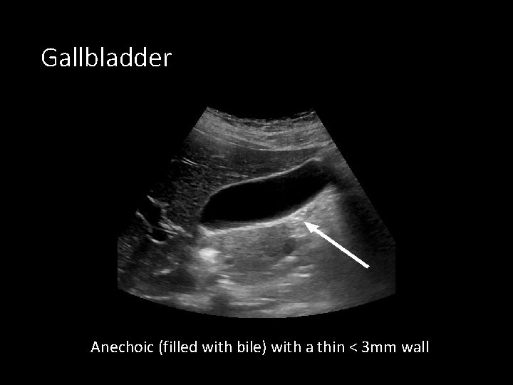 Gallbladder Anechoic (filled with bile) with a thin < 3 mm wall 