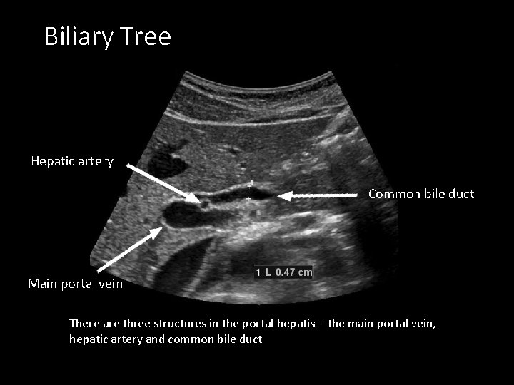 Biliary Tree Hepatic artery Common bile duct Main portal vein There are three structures