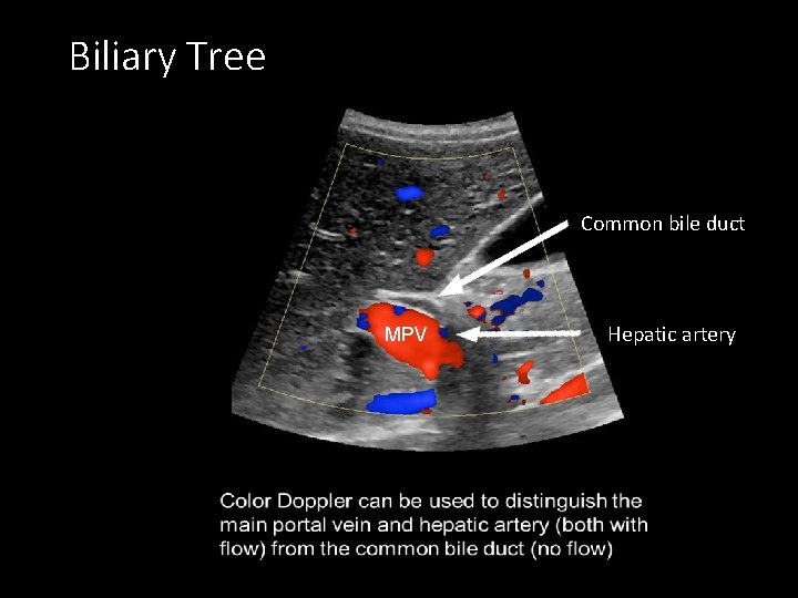 Biliary Tree Common bile duct MPV Hepatic artery 
