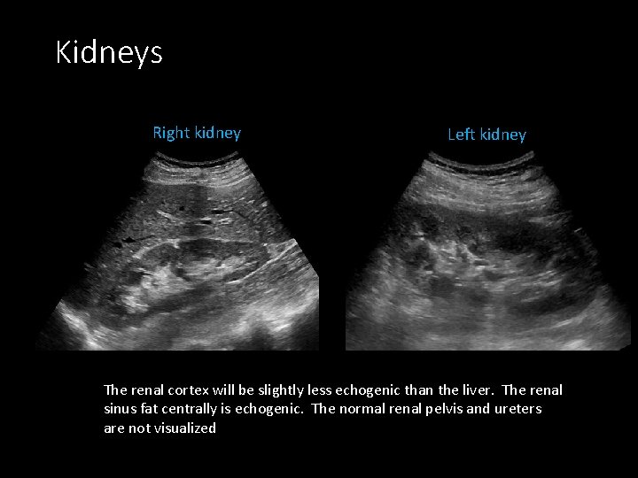 Kidneys Right kidney Left kidney The renal cortex will be slightly less echogenic than