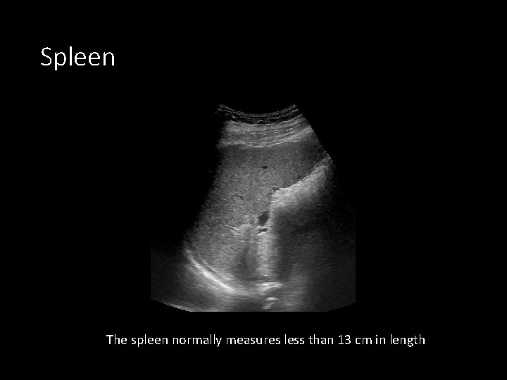 Spleen The spleen normally measures less than 13 cm in length 