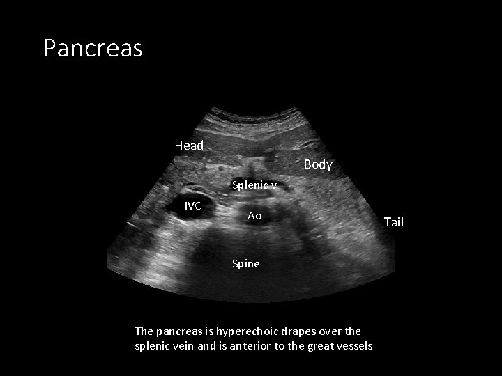 Pancreas Head Body Splenic v IVC Ao Spine The pancreas is hyperechoic drapes over
