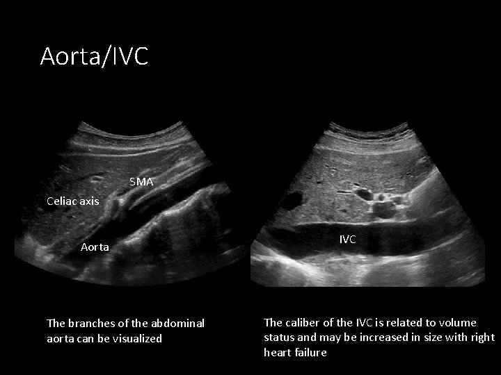 Aorta/IVC SMA Celiac axis Aorta The branches of the abdominal aorta can be visualized