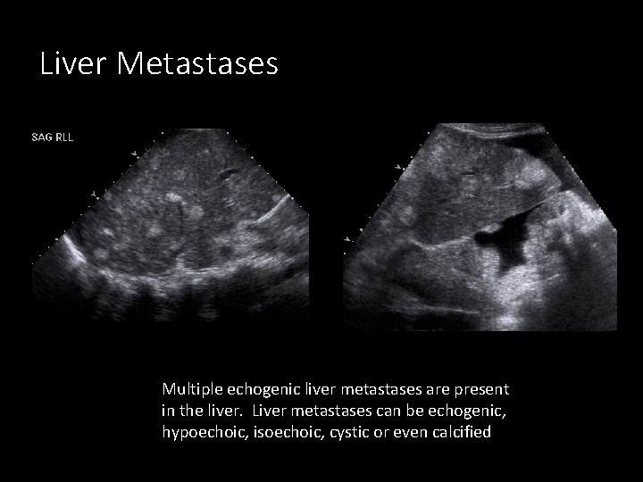 Liver Metastases Multiple echogenic liver metastases are present in the liver. Liver metastases can