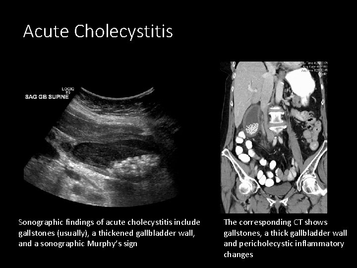 Acute Cholecystitis Sonographic findings of acute cholecystitis include gallstones (usually), a thickened gallbladder wall,