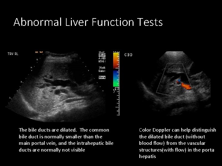 Abnormal Liver Function Tests The bile ducts are dilated. The common bile duct is