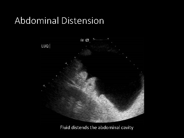 Abdominal Distension Fluid distends the abdominal cavity 