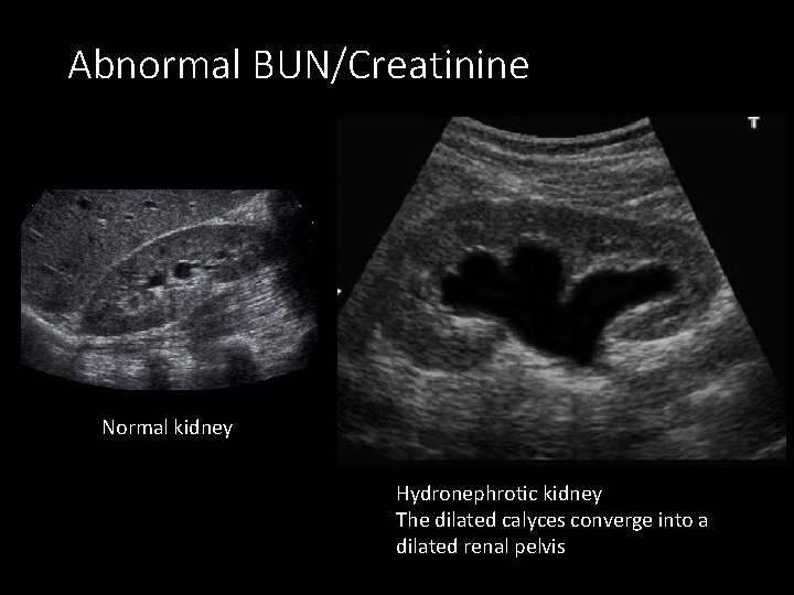 Abnormal BUN/Creatinine Normal kidney Hydronephrotic kidney The dilated calyces converge into a dilated renal