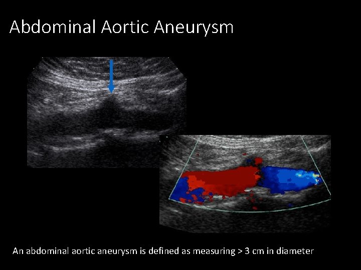 Abdominal Aortic Aneurysm An abdominal aortic aneurysm is defined as measuring > 3 cm