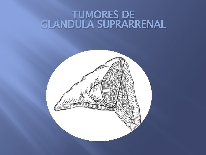 TUMORES DE GLÁNDULA SUPRARRENAL 