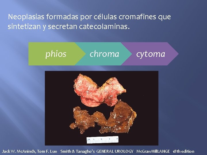 Neoplasias formadas por células cromafines que sintetizan y secretan catecolaminas. phios chroma cytoma Jack