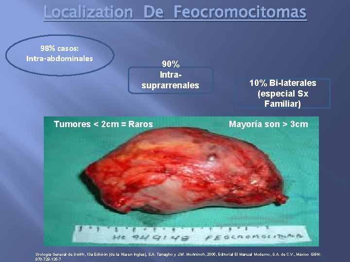 Localization De Feocromocitomas 98% casos: Intra-abdominales 90% Intrasuprarrenales Tumores < 2 cm = Raros