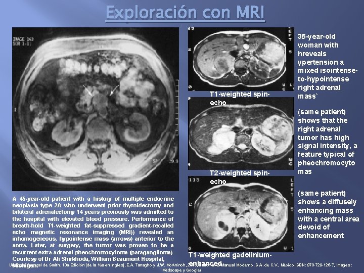 Exploración con MRI T 1 -weighted spinecho T 2 -weighted spinecho 35 -year-old woman