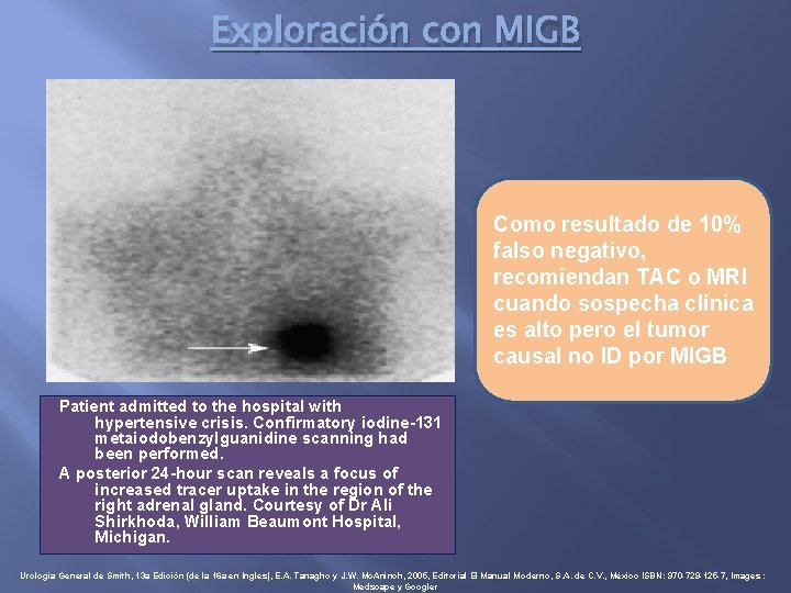 Exploración con MIGB Como resultado de 10% falso negativo, recomiendan TAC o MRI cuando