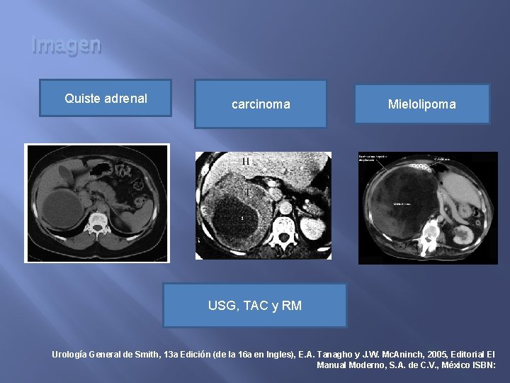 Imagen Quiste adrenal carcinoma Mielolipoma USG, TAC y RM Urología General de Smith, 13