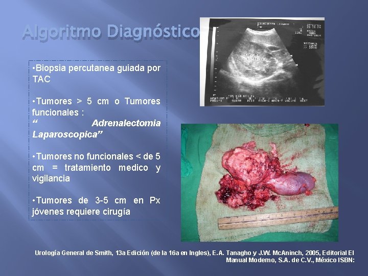 Algoritmo Diagnóstico • Biopsia percutanea guiada por TAC • Tumores > 5 cm o
