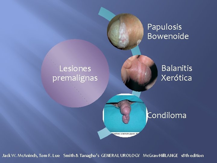Papulosis Bowenoide Lesiones premalignas Balanitis Xerótica Condiloma Jack W. Mc. Aninch, Tom F. Lue