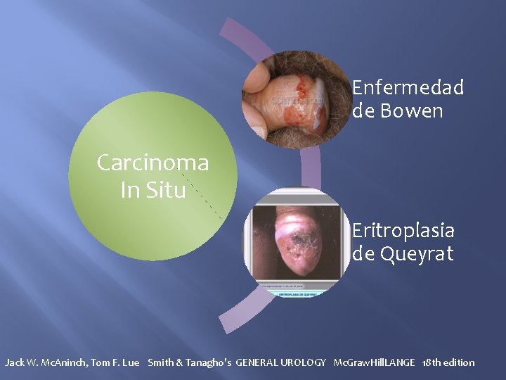 Enfermedad de Bowen Carcinoma In Situ Eritroplasia de Queyrat Jack W. Mc. Aninch, Tom