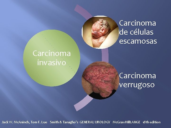 Carcinoma de células escamosas Carcinoma invasivo Carcinoma verrugoso Jack W. Mc. Aninch, Tom F.