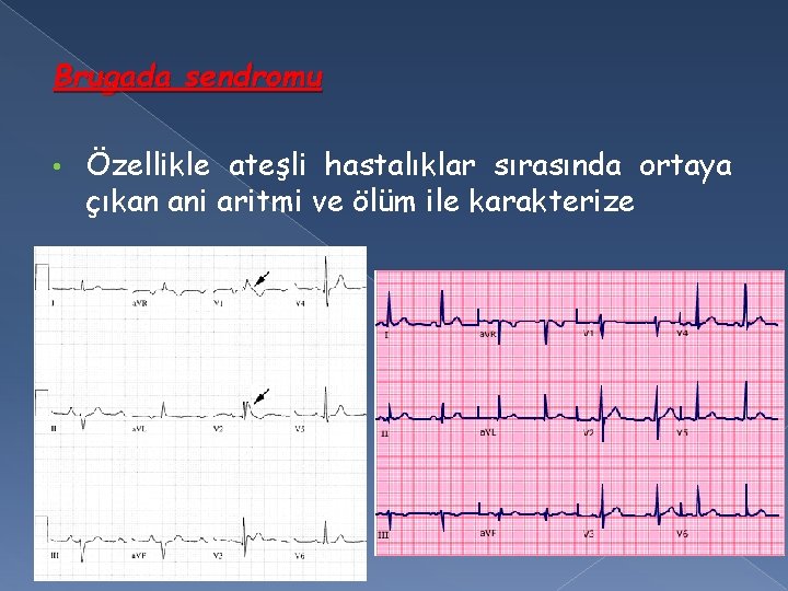 Brugada sendromu • Özellikle ateşli hastalıklar sırasında ortaya çıkan ani aritmi ve ölüm ile