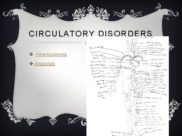 CIRCULATORY DISORDERS v Atherosclerosis v Aneurysm 