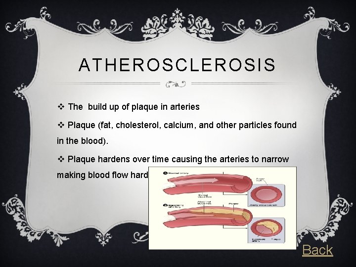 ATHEROSCLEROSIS v The build up of plaque in arteries v Plaque (fat, cholesterol, calcium,