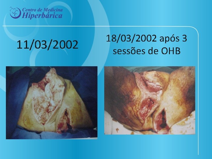 11/03/2002 18/03/2002 após 3 sessões de OHB 