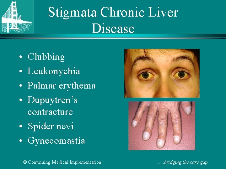 Stigmata Chronic Liver Disease • • Clubbing Leukonychia Palmar erythema Dupuytren’s contracture • Spider