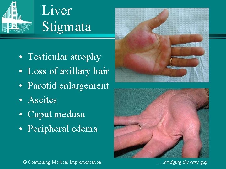 Liver Stigmata • • • Testicular atrophy Loss of axillary hair Parotid enlargement Ascites