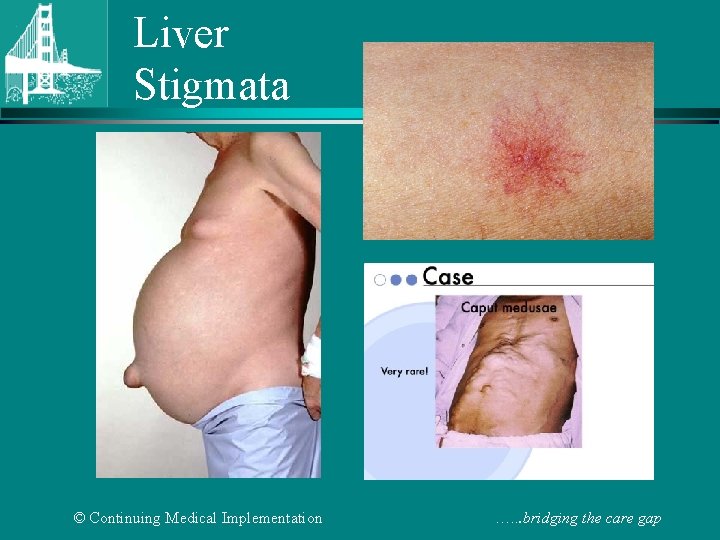 Liver Stigmata © Continuing Medical Implementation …. . . bridging the care gap 