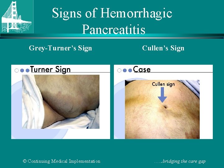 Signs of Hemorrhagic Pancreatitis Grey-Turner’s Sign © Continuing Medical Implementation Cullen’s Sign …. .