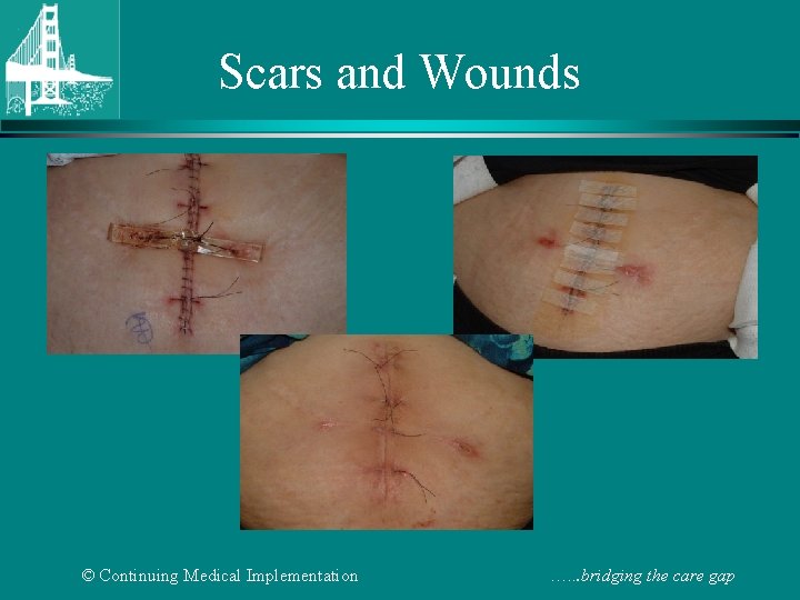 Scars and Wounds © Continuing Medical Implementation …. . . bridging the care gap