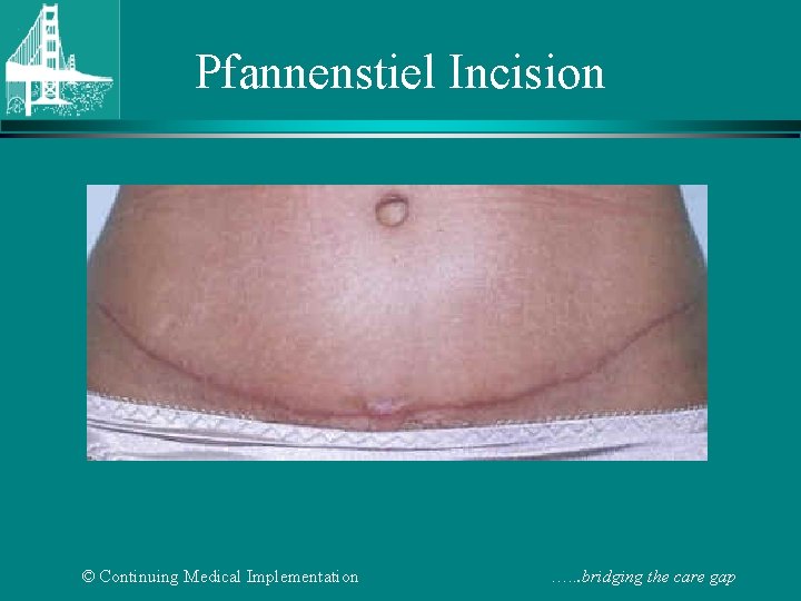 Pfannenstiel Incision © Continuing Medical Implementation …. . . bridging the care gap 