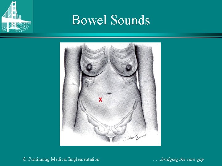 Bowel Sounds © Continuing Medical Implementation …. . . bridging the care gap 