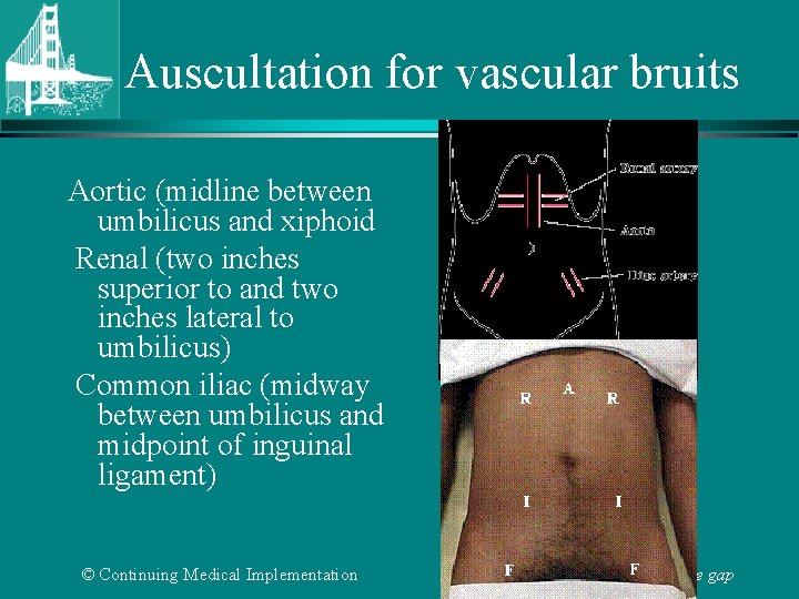 Auscultation for vascular bruits Aortic (midline between umbilicus and xiphoid Renal (two inches superior