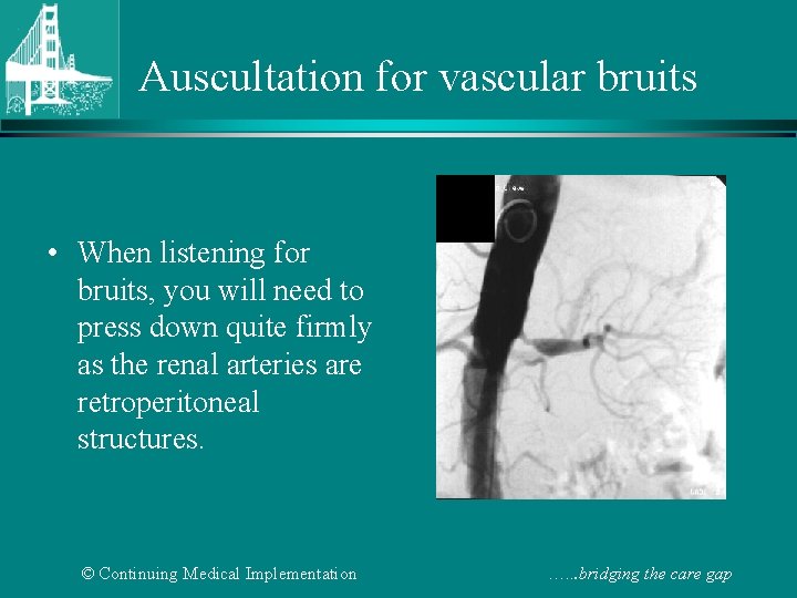 Auscultation for vascular bruits • When listening for bruits, you will need to press