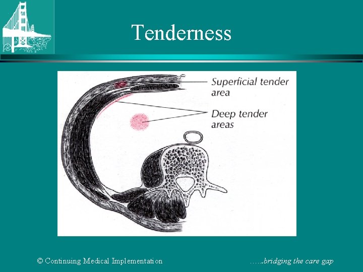 Tenderness © Continuing Medical Implementation …. . . bridging the care gap 