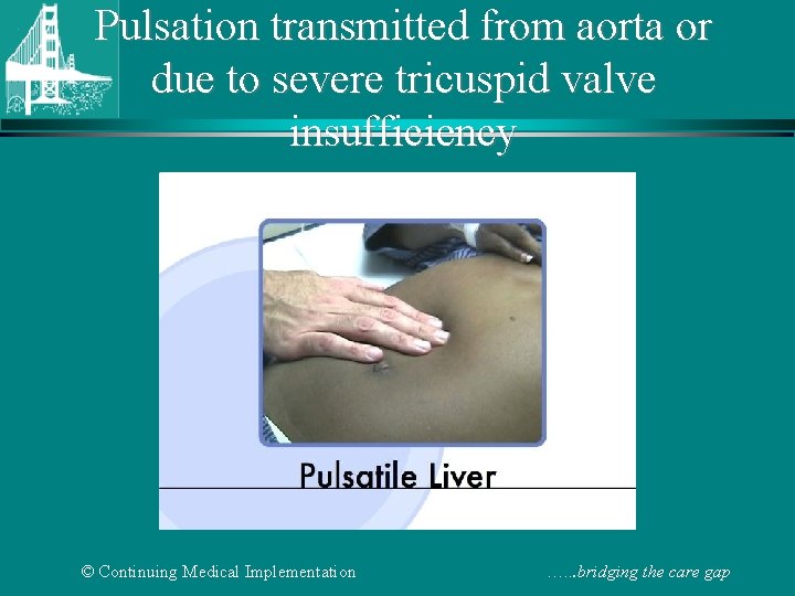 Pulsation transmitted from aorta or due to severe tricuspid valve insufficiency © Continuing Medical