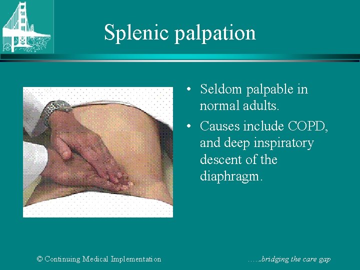 Splenic palpation • Seldom palpable in normal adults. • Causes include COPD, and deep