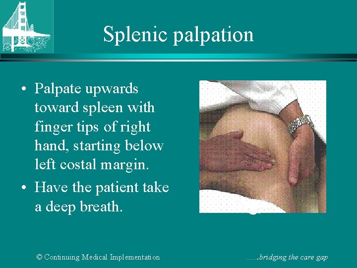 Splenic palpation • Palpate upwards toward spleen with finger tips of right hand, starting