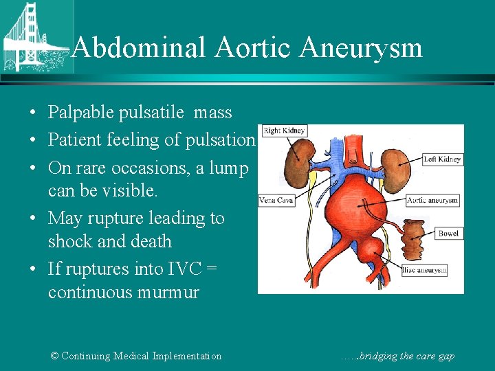 Abdominal Aortic Aneurysm • Palpable pulsatile mass • Patient feeling of pulsation • On