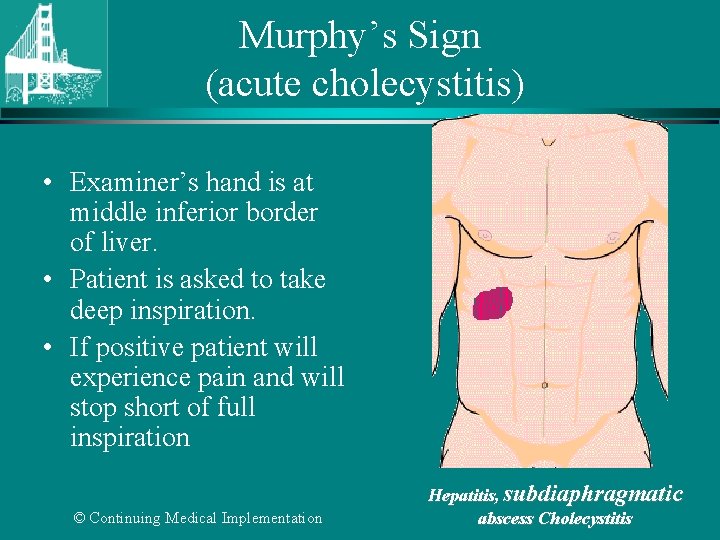Murphy’s Sign (acute cholecystitis) • Examiner’s hand is at middle inferior border of liver.