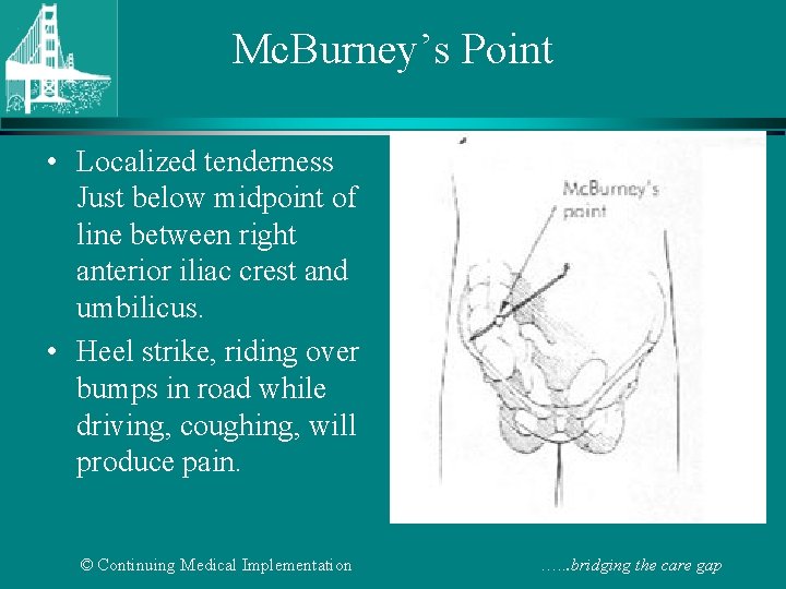 Mc. Burney’s Point • Localized tenderness Just below midpoint of line between right anterior