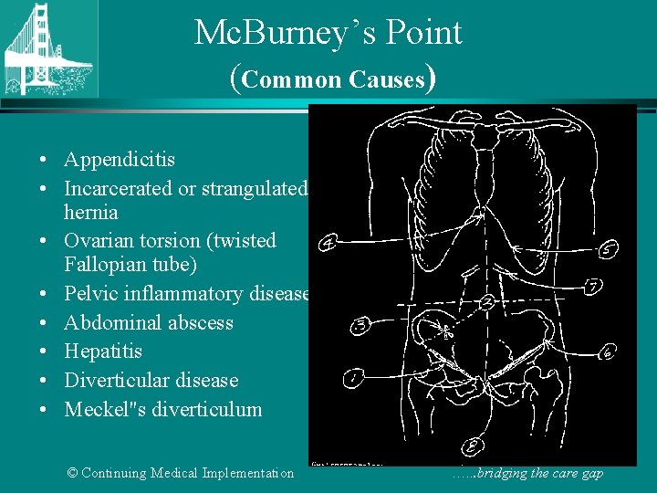 Mc. Burney’s Point (Common Causes) • Appendicitis • Incarcerated or strangulated hernia • Ovarian
