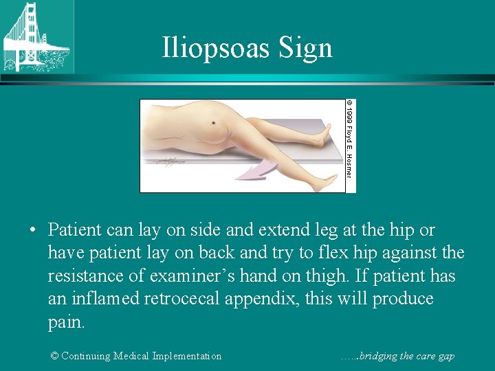 Iliopsoas Sign • Patient can lay on side and extend leg at the hip