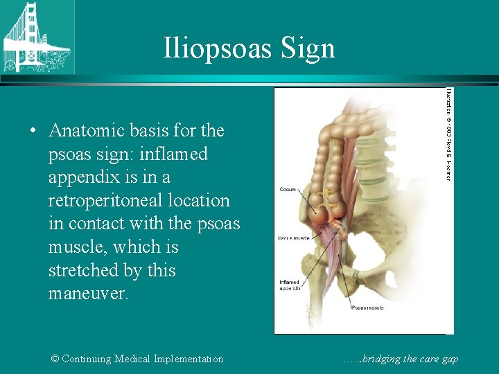 Iliopsoas Sign • Anatomic basis for the psoas sign: inflamed appendix is in a