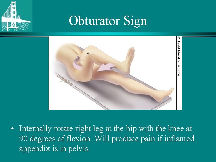 Obturator Sign • Internally rotate right leg at the hip with the knee at