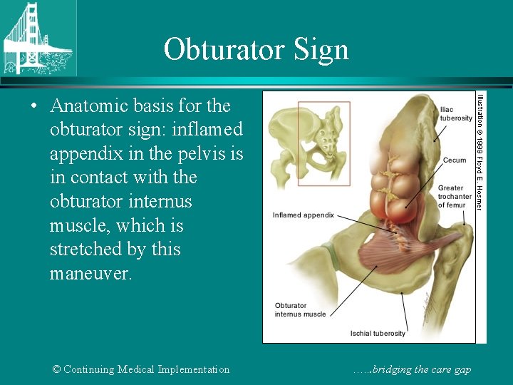 Obturator Sign • Anatomic basis for the obturator sign: inflamed appendix in the pelvis