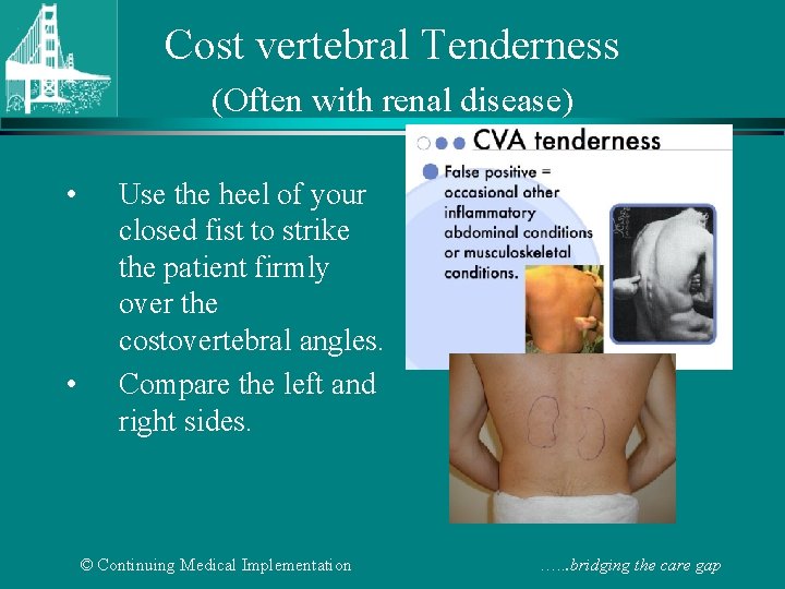 Cost vertebral Tenderness (Often with renal disease) • • Use the heel of your